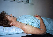 An example of Electro Acupuncture